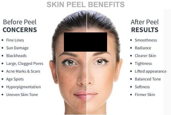 Skin Peel Benefits — Before and After